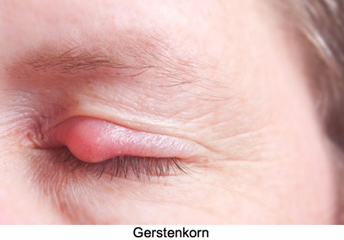 Gerstenkorn / Hordeolum