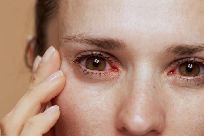 Rote Augen bei Allergie